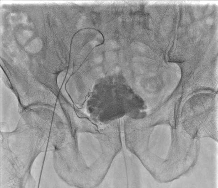 Pelvic Angiography Img